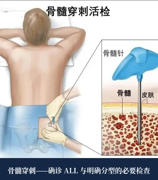 急性淋巴细胞白血病的最新治疗方案（2026版）